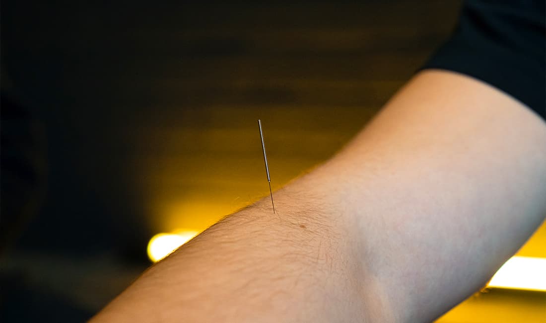 Dry needling naald in een arm.